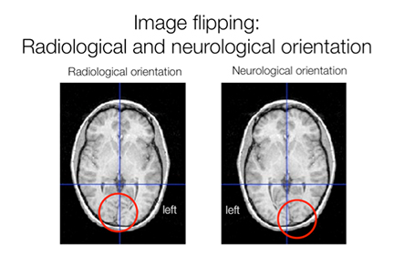 نمایش تصویر  MRI با استفاده از  قرارداد های نورولوژیکی و رادیولوژیکی