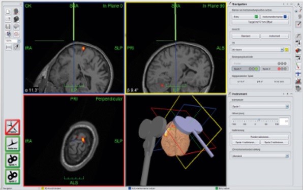شبیه‌سازی مغز و تعیین نواحی هدف در سیستم هدایتگر(Navigation) با استفاده از MRI فرد 