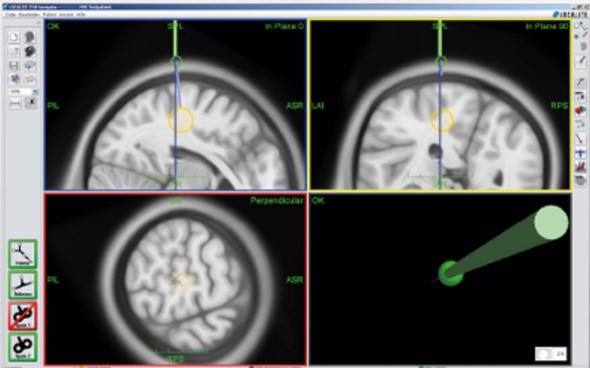 Figure 4: MR-Less Navigation System supports navigated stimulation using MNI atlas, without MRI