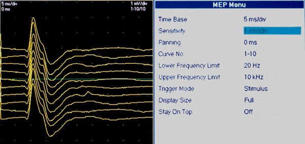 Figure 6: MEP signal recording using MEP option