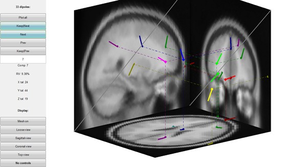 Source visualizaion on MRI images
