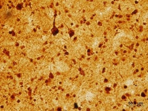 تصویر رنگ آمیزی شده LSD1 که از مغز یک فرد دچار آلزایمر گرفته شده، الگوهایی مشابه پروتئین تاو را شبیه سازی می کند.