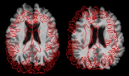 نمونه ای از  تبدیل rigid body در تصاویر MRI