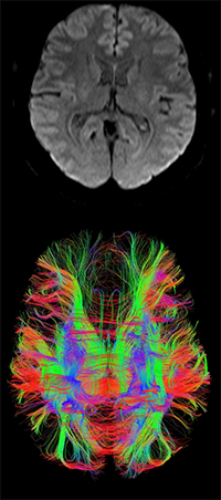 An example of DTI analysed data (whole brain tractography)