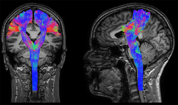 An example of DTI-drived CST tractography