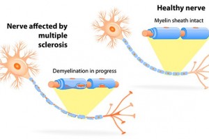 New tech for multiple sclerosis diagnosis and treatment
