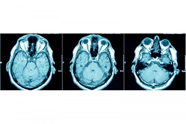Fast MRIs offer alternative to CT scans for pediatric head injuries