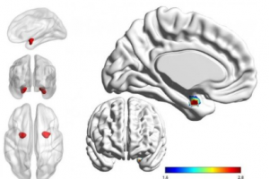 اسکن‌های مغزی می‌توانند افسردگی را از اختلال دوقطبی تمییز دهند