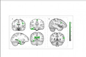 Brains of children with a better physical fitness possess a greater volume of gray matter