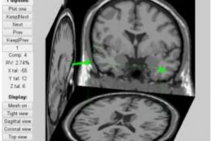 تعیین کمی انطباق در مکان یابی کانون‌های صرع توسط EEG-fMRI مبتنی بر مؤلفه