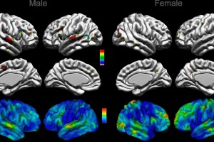 A step toward better understanding brain anatomy of autism spectrum disorder