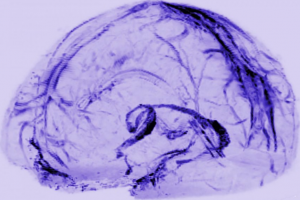 کشف اولین شواهد از سیستم دفع ضایعات در مغز انسان 