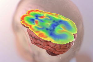 Higher brain glucose levels may mean more severe Alzheimer’s