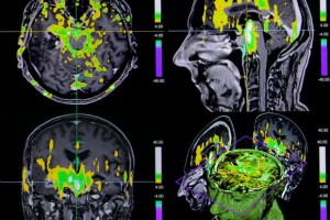 الگوی اتصالات مغزی در fMRI افراد مبتلا به میگرن مزمن و میگرن اپیزودیک متفاوت است