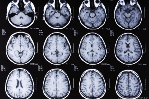روش تصویربرداری جدید مغز آسیب‌های مخفی مغزی را نشان می‌دهد