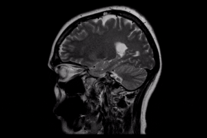 MRI نشان می‌هد که اوتیسم، تغییرات قابل توجهی در ماده سفید مغز ایجاد می‌کند. 