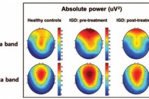 Associations between prospective symptom changes and slow-wave activity in patients with Internet gaming disorder: A resting-state EEG study