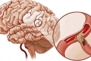 نارسانویسی در بیماران ایرانی دارای سکته مغزی سمت راست