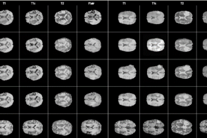 AI algorithm produces synthetic brain MR images