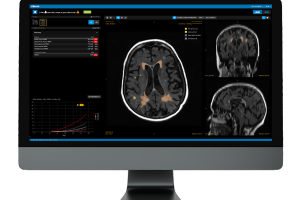 MRI  مجهز به قدرت هوش مصنوعی برای مراقبت از بیمار مبتلا به ام.اس و اختلالات مغزی 