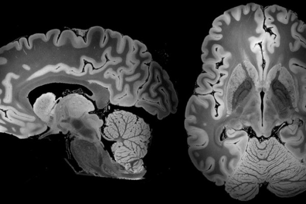 یک اسکن MRI که ۱۰۰ ساعت به طول انجامید، توانست دقیق‌ترین تصویر از مغز انسان را به ثبت برساند
