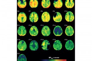 روش جدید مبتنی بر PET، کلاف¬های پروتئینی را پس از آسیب خارجی مغزی به تصویر می‌کشد