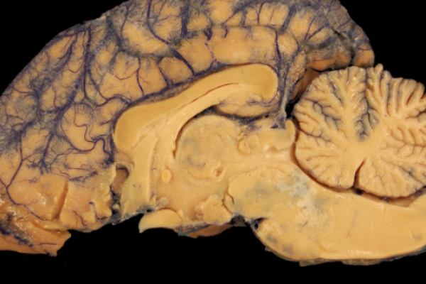 Neuroscientist Discovers Hidden Region in the Human Brain