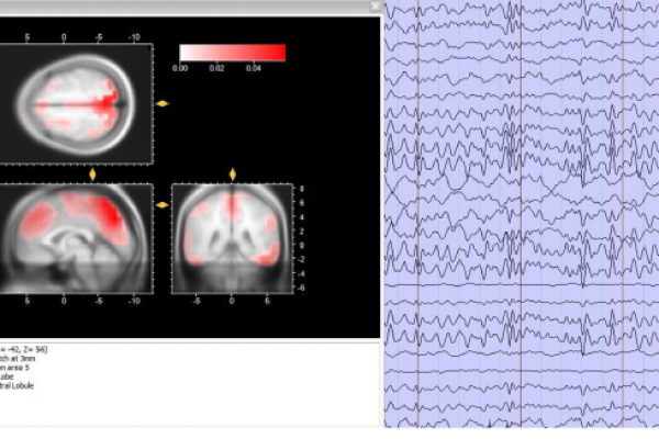 EEG-fMRI همزمان برای ارزیابی عملکرد عصبی