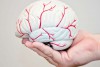  آسیب خفیف سر هم احتمال سکته مغزی را افزایش می دهد