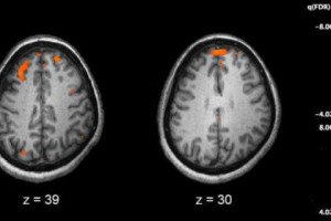 Researchers identify brain changes in schizophrenia patients