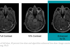 هوش مصنوعی می‌تواند به کاهش دوز گادولینیوم در MRI کمک کند!