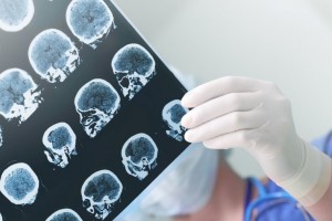 چشم انداز امیدبخش درمان سرطان با استفاده از تصویربرداری تشدید مغناطیسی (MRI) و هوش مصنوعی (AI)