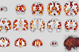 Similarity between Schizophrenia and Dementia Discovered for the First Time