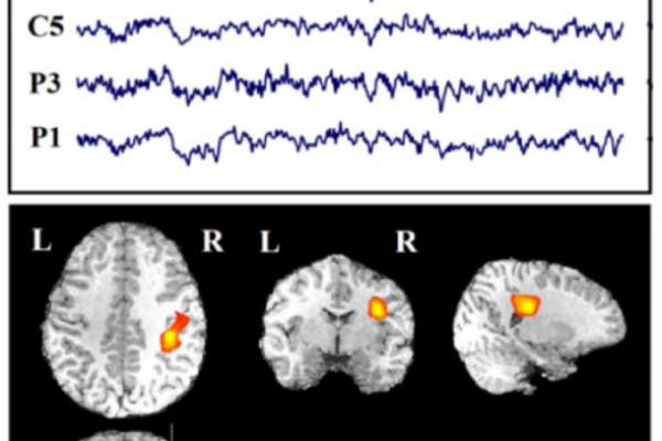مکان‌یابی کانون‌های صرع از طریق پردازش EEG-fMRI هم زمان و شناسایی خودکار اینترایکتال از EEG داخل اسکنر