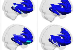 Brain activity found to be predictive of pain-related fear