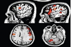 کاربردهای جدیدfMRI  در صرع دوران کودکی، شناخت تاثیرات تشنج را افزایش می‌دهد
