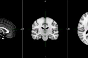 پردازش تصاویر fMRI - قسمت هفدهم