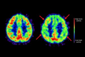نشانگر زیستی جدید تصویربرداری PET می‌تواند پیشرفت بیماری آلزایمر را بهتر پیش‌بینی کند
