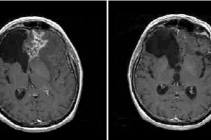 بهبود تصویربرداری مولکولی هدفدار MRI در مغز؛ مقایسه‌ی تجربی بین توالی‌ها و ذرات مختلف