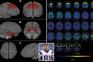 بررسی شدت ماده سفید در MRI و ضایعات مغزی ناشی از ضربه‌های مکرر به سر ورزشکاران