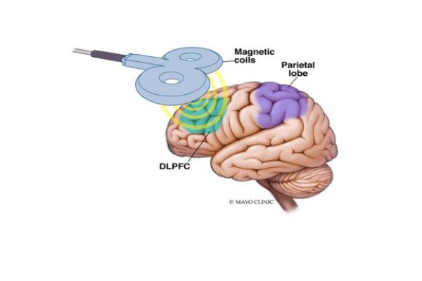 تحریک مغناطیسی مغز می تواند حافظه اپیزودیک را بهبود بخشد