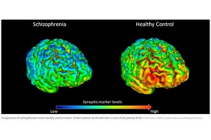 New imaging method reveals lack of key brain protein in schizophrenia